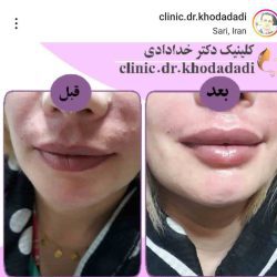 دکتر خدادادی تزریق ژل لب ساری