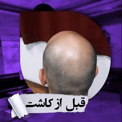 اینستاگرام کلینیک کاشت مو پدیده ساری