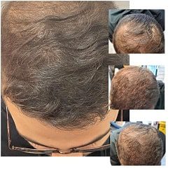 بهترین کلینیک کاشت مو ساری