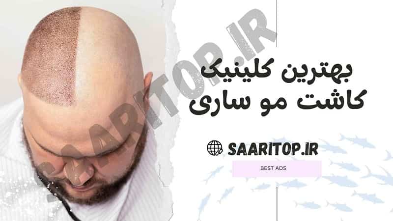 بهترین کلینیک کاشت مو ساری