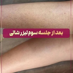 لیزر ساری