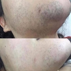 دستگاه لیزر ساری