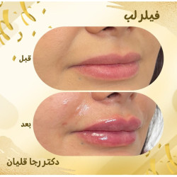 بهترین دکتر تزریق ژل لب ساری