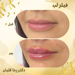 اینستاگرام دکتر رجا قلیان تزریق ژل ساری