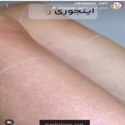 اینستاگرام کلینیک لیزر رها ساری