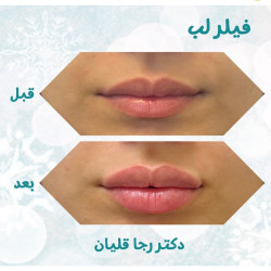 دکتر رجا قلیان تزریق ژل ساری