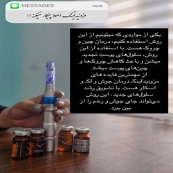 مزونیدلینگ برنا |مزونیدلینگ ساری