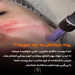 اینستاگرام کلینیک مزونیدلینگ الگانت ساری