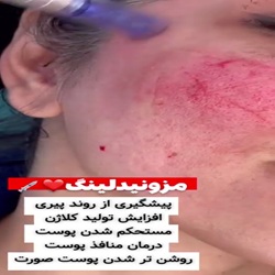 بهترین مزونیدلینگ ساری