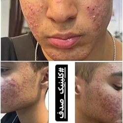 بهترین مزونیدلینگ ساری