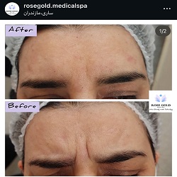 بهترین مزونیدلینگ ساری