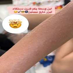 بهترین کلینیک لیزر بابل