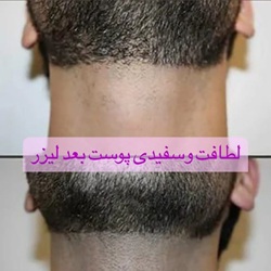 بهترین کلینیک لیزر بابل